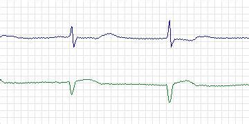 mit-bih ecg compression test database|Physiobank .